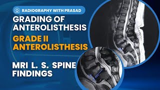 Understanding Grade II Anterolisthesis in the Lumbar Spine  Causes Symptoms and Solutions [upl. by Yeldnarb]