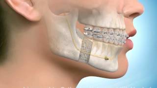Chirurgische kaakcorrectie onderkaak [upl. by Fraze]