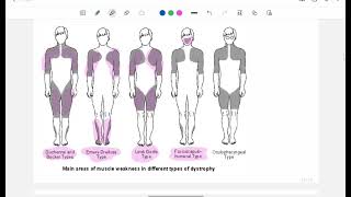 Myopathies part 3  Inherited myopathies  Harrison made easy [upl. by Yud]