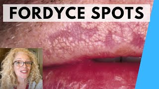 SYRINGOMA VS FORDYCE SPOTS  NATURAL REMEDIES [upl. by Eeramit]