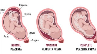 Low Lying Placenta in Pregnancy  Explained in Kannada  Dr Sindhu Ravishankar [upl. by Htebazileyram199]