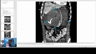 Hepatic Adenoma Imaging [upl. by Inaboy520]