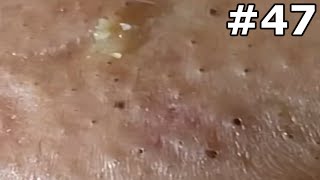 quot🔴 Satisfying Pimple Popping Extravaganza Watch the Most Satisfying Pops Everquot 47 [upl. by Annunciata]