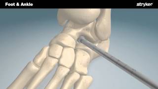 Stryker Foot and Ankle  SubFix™ Arthroeresis Implant Animation [upl. by Ahsaz]