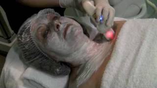 Tratamiento de radiofrecuencia facial [upl. by Silecara]