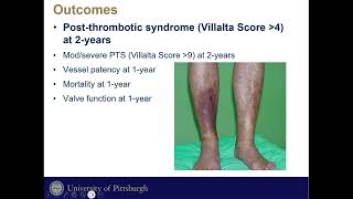 Post Thrombotic Syndrome Morbidity In Mechanical Thrombectomy Vs CDT of Iliofemoral DVT [upl. by Zimmer448]