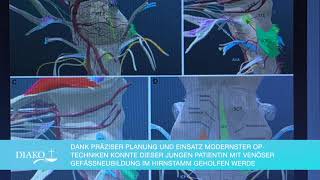 Erfolgreiche OP eines HirnstammCavernoms in Flensburg mit 4K und 3D Neurochirurgie in Flensburg [upl. by Sug]