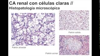 Carcinoma de células renales [upl. by Ridan]