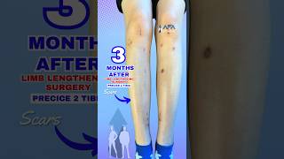 4 MONTHS AFTER LIMB LENGTHENING SURGERY PRECICE 2 TIBIA limblengtheningsurgery heightincrease [upl. by Adnomal]