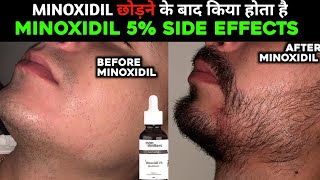 minoxidil chodne ke baad kya kare  minoxidil side effects  how to quit minoxidil for beard [upl. by Ok]