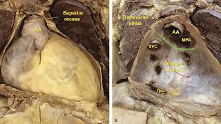 Sinuses of pericardium  heart Anatomy [upl. by Tobye5]