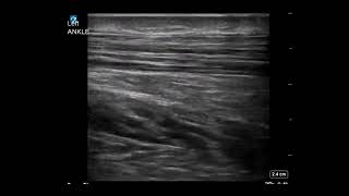 Ankle Ultrasound Achilles Tendonitis With Enthesophyte [upl. by Arlette]