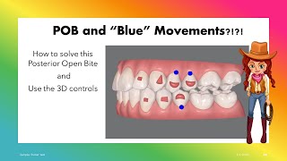 Invisalign ClinCheck  Solve Posterior OpenBite with 3D controls [upl. by Cullan166]