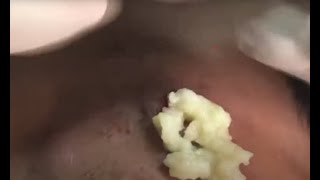 Crazy Satisfying cyst and Blackheads Remove 2024 [upl. by Yeleen]