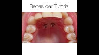 MiniImplant Placement and Beneslider Insertion [upl. by Rorrys]