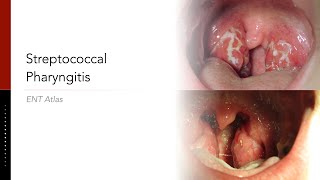 Streptococcal Pharyngitis [upl. by Tavey627]