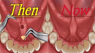 Stone Removal from tonseil Treatment ASMR Animation asmr animation tonsils gaming health game [upl. by Elhsa]