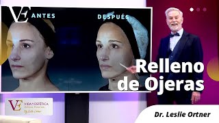 RELLENO DE OJERAS CON ÁCIDO HIALURÓNICO  DR LESLIE ORTNER [upl. by Artemahs]