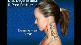 Cervical Disc Degeneration [upl. by Bernadina848]