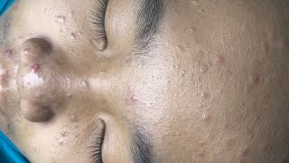 ACNE TREATMENT VU QUYNH MI  Blackheads Chin amp Nose Of Tweens 2024 EX [upl. by Eilrahc]