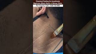 Chemical peeling for acanthosis nigricans black neck at skinaa clinic Viral shorts [upl. by Kirad]