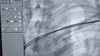 Radiographic Appearance of Pacemaker Dual Chamber explained by Prof Dr Vivek Gupta 2023 [upl. by Terrance]