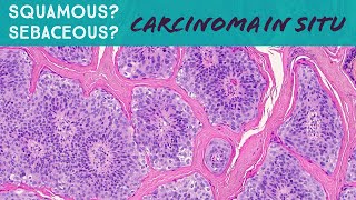 Squamous cell carcinoma in situ with vacuoles vs Sebaceous carcinoma in situ Dermpath in 5Minutes [upl. by Atiran]