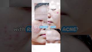 Azelaic Acid is all you need acnesolution accuresy skincare accufix accutane acnetreatment [upl. by Lukasz]