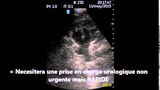 Uretero Hydronephrose moderee Echographe de poche Vscan utile en urologie aux urgences [upl. by Kerwon180]