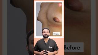 Before amp After Gynecomastia Surgery  Post Gynecomastia Surgery Scar  shorts [upl. by Aunson868]