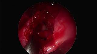 Management of Onodi cells in endoscopic sinus surgery [upl. by Lukin234]