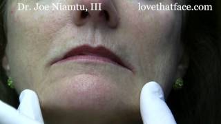 Botox Injection to DAO corner of mouth by Dr Joe Niamtu III [upl. by Ajnotal]