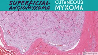 Cutaneous Myxoma aka Superficial Angiomyxoma [upl. by Nnednarb]