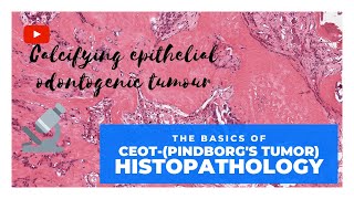 CEOT  Histopathology MUST KNOW FEATURES [upl. by Enogitna]