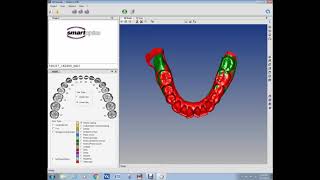 Pointpair registration of 3D dental arches STL models in CloudCompare [upl. by Aisatan]