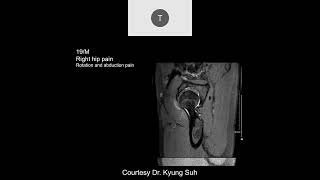 MRI of the Hip Part 6 – Hip Trauma [upl. by Olia]