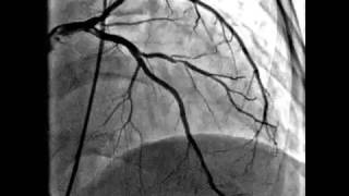 Coronary artery angioplasty video [upl. by Anaehs]