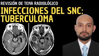 Radiología en 5 minutos Infecciones del sistema nervioso central Tuberculoma [upl. by Avron]