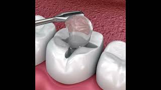 Teeth Inlays and Onlays  All Brite Dentistry inlay onlay dentist [upl. by Klemm246]