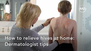 How to relieve hives at home [upl. by Mercado]