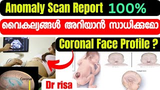 Anomaly Scan Malayalam5th Month Scan In Pregnancy [upl. by Carole485]