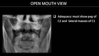 Clearing Cspine on XRay Diagnosing Cervical spine fractures [upl. by Ikkir52]