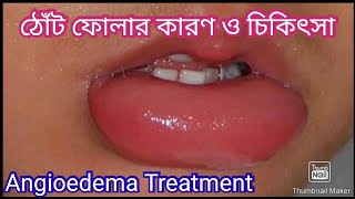 ঠোঁট ফোলার কারণ  ঠোঁট ফোলা কমানোর উপায়  Angioedema Treatment [upl. by Annola]