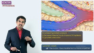 2Edema Pathogenesis  Hemodynamic pathology Fmge amp Neet PG [upl. by Shelly]