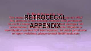 Retrocecal Appendix [upl. by Gusti108]