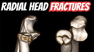 Radial Head Fractures Presentation  Orthopaedics High Yield Topics 16 [upl. by Thad430]