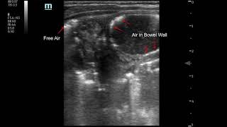 NEC Air in Bowel Wall consistent with Pneumatosis Intestinalis [upl. by Nitsirhc]