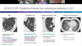 Hot Topics in ILD Diagnosis MDD Genomics and PF ILD [upl. by Dympha]