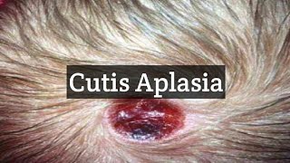 Cutis Aplasia  A skin Condition With Missing Skin Areas [upl. by Ennaeerb365]