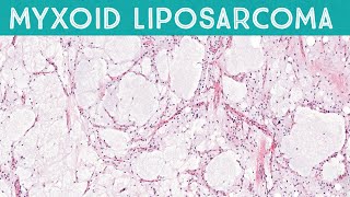 Myxoid liposarcoma high grade formerly round cell liposarcoma AIP France 2021 [upl. by Citarella]